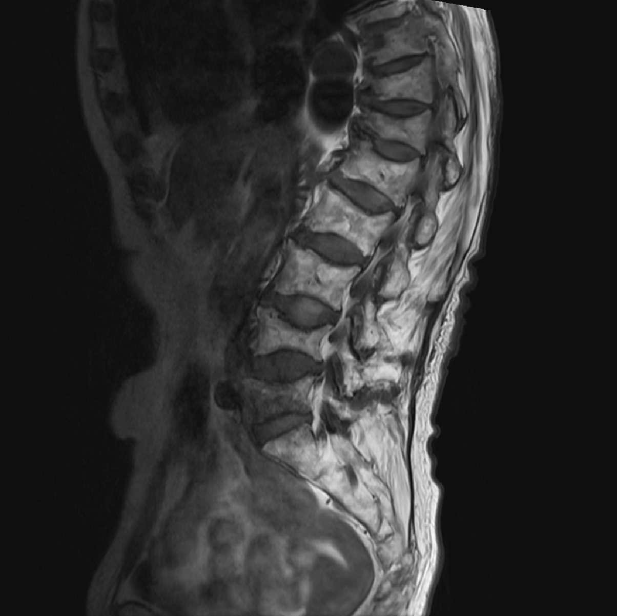 통증치료 및 경과관찰을 위한 멀티모달리티 데이터-질환별 라벨링 예시_6_골다공증성 통증 OP(Osteoporotic Fracture) MRI