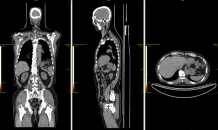 핵의학영상(PET) 이미지-데이터 포맷_2_3D CT 이미지