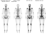 통증치료 및 경과관찰을 위한 멀티모달리티 데이터-데이터 종류 예시_4_Bone scan 예시