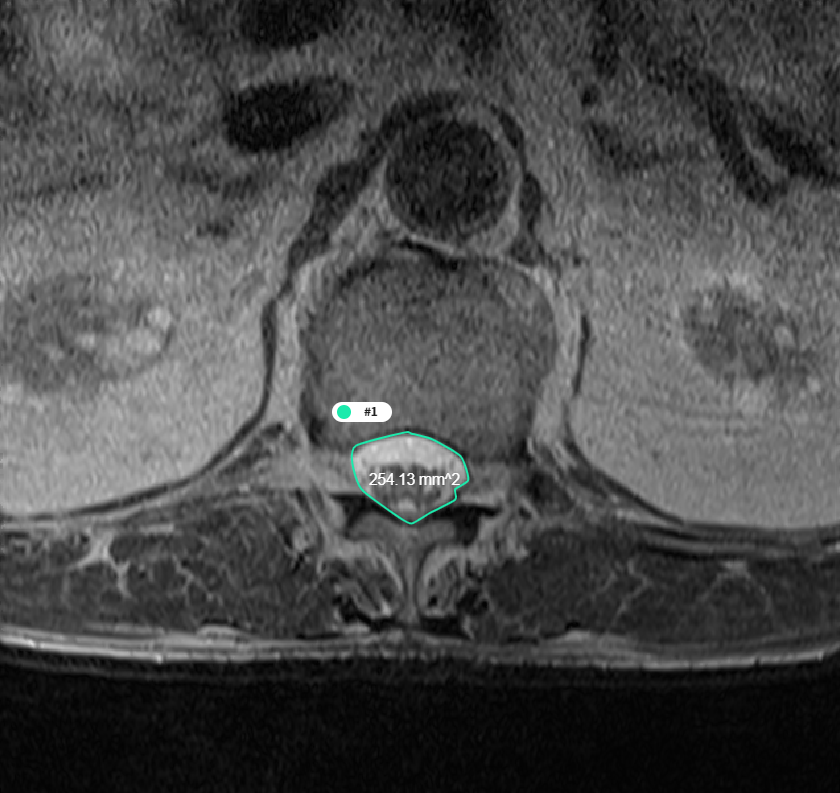 퇴행성 척추질환 진단 및 치료를 위한 멀티모달리티 데이터-질환별 라벨링 예시-흉추 척수증(DTM)-MRI