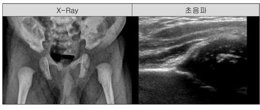 영유아 고관절 데이터-원천 데이터-X-Ray, 초음파 이미지