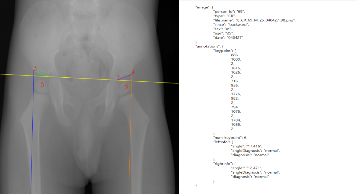 영유아 고관절 데이터-라벨링 데이터 구조(X-Ray)-X-Ray 이미지