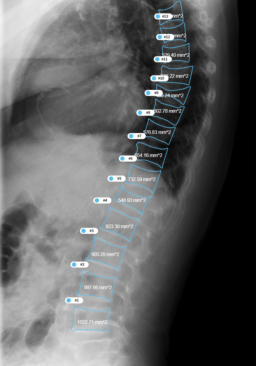 통증치료 및 경과관찰을 위한 멀티모달리티 데이터-질환별 라벨링 예시_5_골다공증성 통증 OP(Osteoporotic Fracture) X-ray