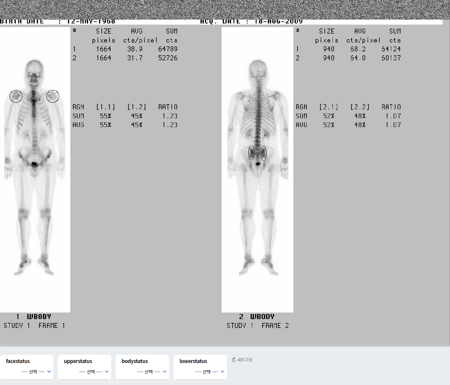 통증치료 및 경과관찰을 위한 멀티모달리티 데이터-질환별 라벨링 예시_10_만성신경병증 통증 CNP(Chronic Neuropathic Pain) Bone scan