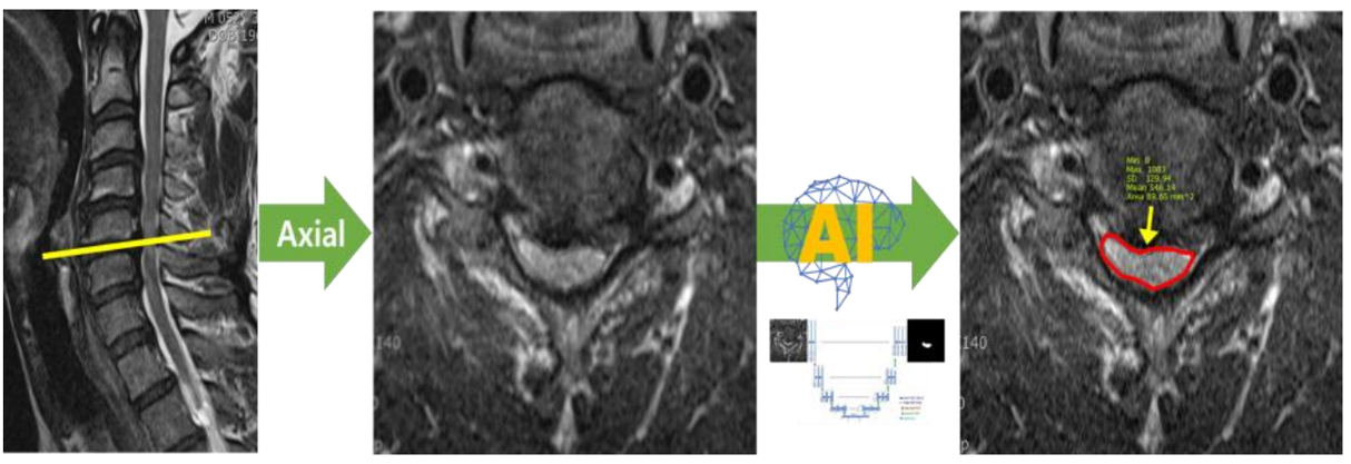 퇴행성 척추질환 진단 및 치료를 위한 멀티모달리티 데이터-T2 Axial에서의 척수 영역 분할 및 면적 측정 모델-T2 MRI에서 척수 영역 분할 모델 개요 이미지
