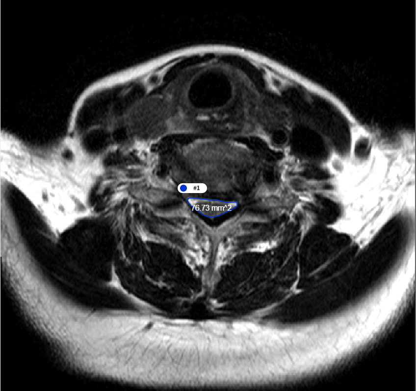 퇴행성 척추질환 진단 및 치료를 위한 멀티모달리티 데이터-질환별 라벨링 예시-퇴행성 경추협착증(DCS)-MRI