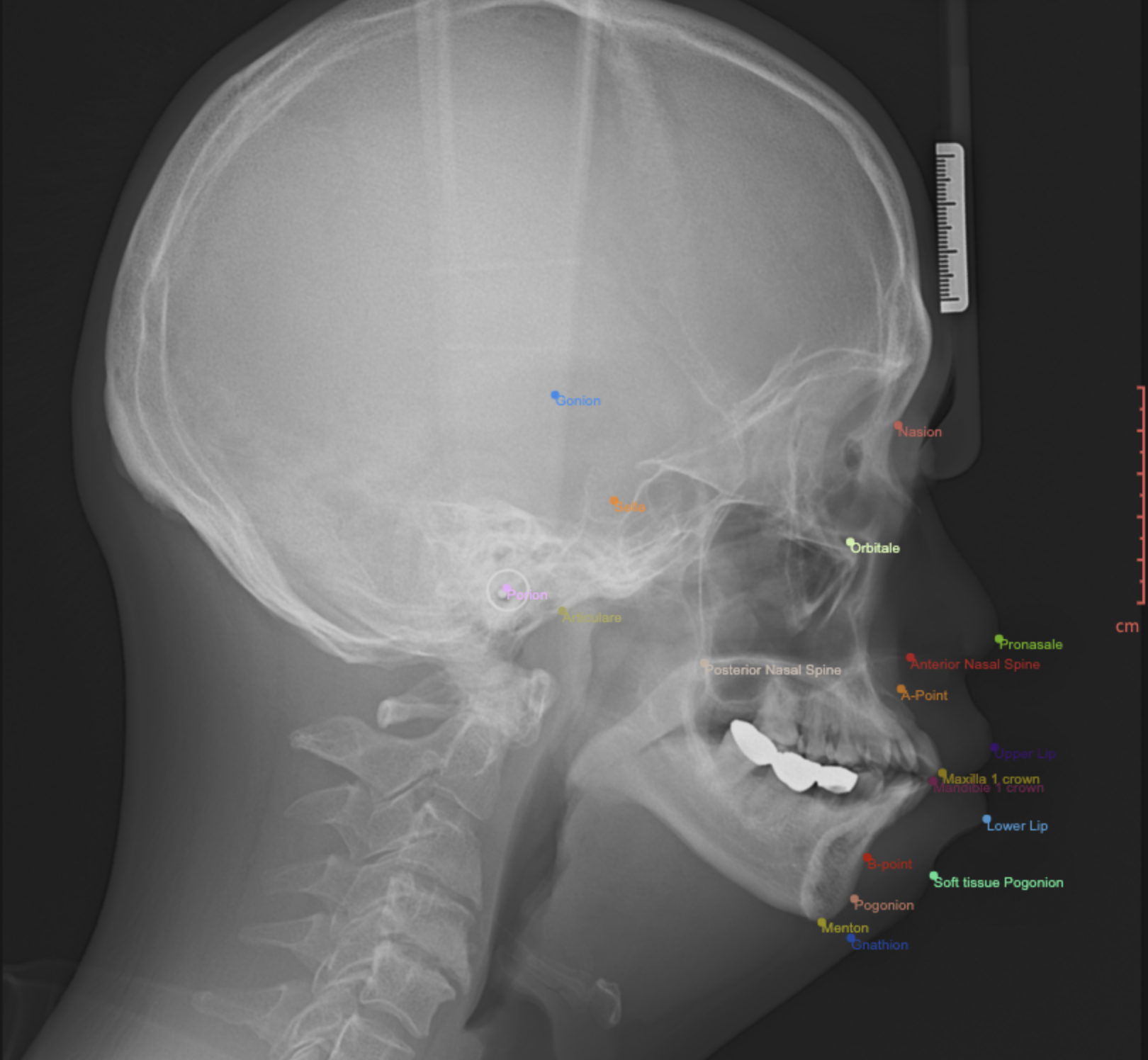 측면두부규격방사선사진(cephalography)-어노테이션 표시 예시 이미지