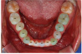 lower 치아경계