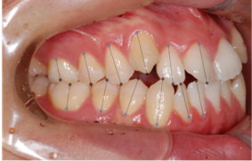 left 치아경계/치축/대구치관계 2