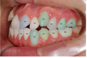 right 치아경계/치축/대구치관계 1