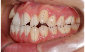 right 치아경계/치축/대구치관계 2