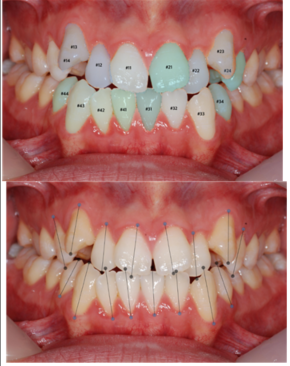 front 치아경계/치축