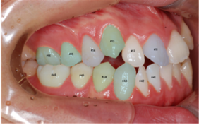 left 치아경계/치축/대구치관계 1