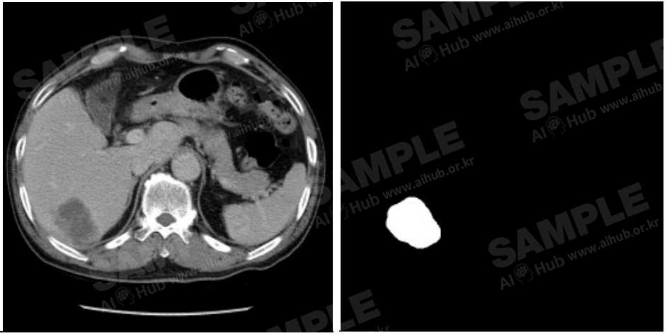 간암 진단 의료 영상-대표도면-좌측 : dcm파일, 우측 : png파일 (병변 라벨링)