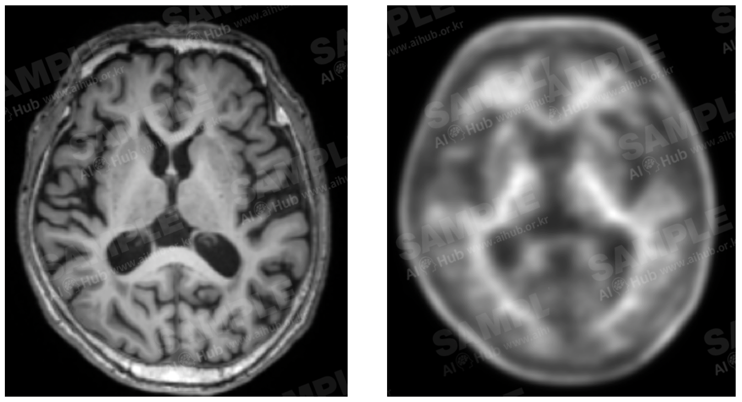치매 진단 의료 영상-대표도면-1-예시 이미지 좌측부터 T1 MRI, PET amyloid 영상