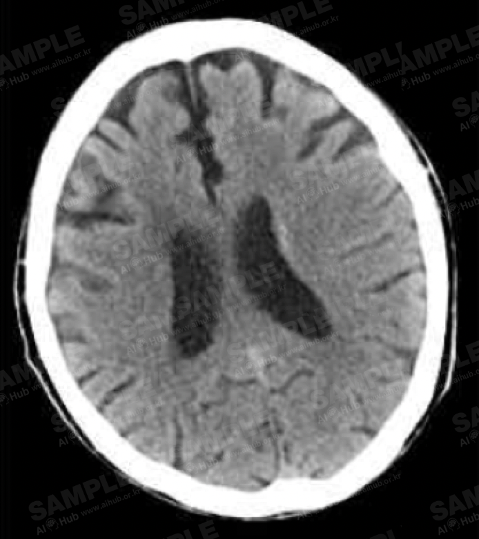 뇌혈관 질환 진단 의료 영상-구축 내용 및 제공 데이터량-두부 CT 영상 예시 이미지