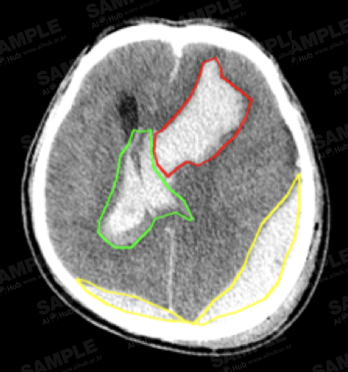 뇌혈관 질환 진단 의료 영상-구축 내용 및 제공 데이터량-다각형 라벨 예시 이미지