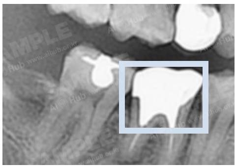 치과 진환 진단 의료 영상-어노테이션 포맷_2_라벨링 대상(보철치료, Prosthesis)