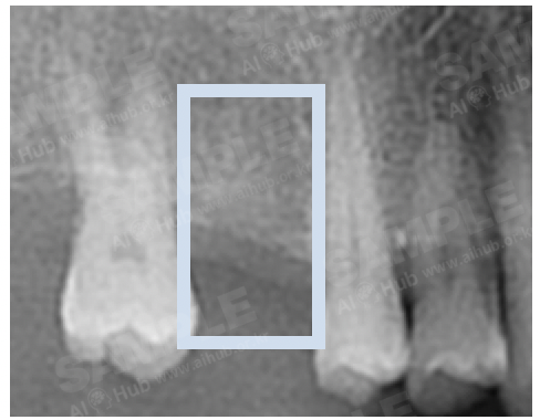 치과 진환 진단 의료 영상-어노테이션 포맷_4_라벨링 대상(결손치아, Missing Teeth)