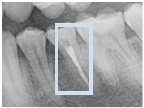 치과 진환 진단 의료 영상-어노테이션 포맷_5_라벨링 대상(근관치료, root canal treatment)