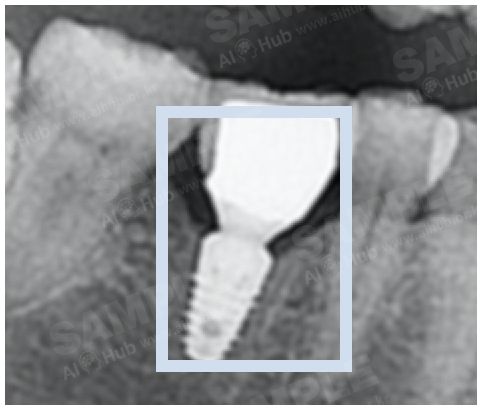 치과 진환 진단 의료 영상-어노테이션 포맷_6_라벨링 대상(치과임플란트, (Dental Implant)