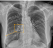 폐암 진단 의료 영상-대표도면-X-ray 예시 이미지