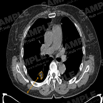 폐암 진단 의료 영상-대표도면-CT 예시 이미지